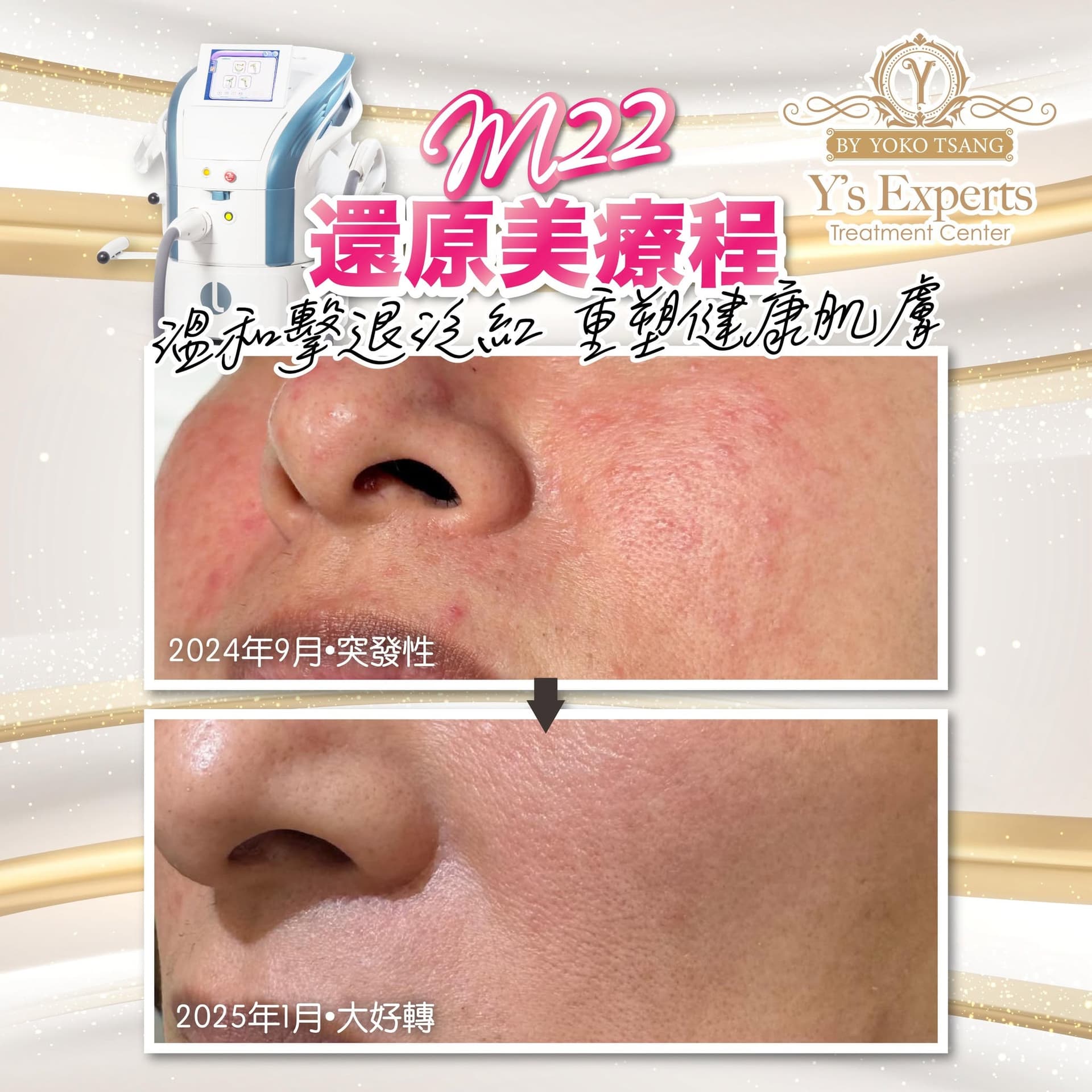 M22 還原美療程 真實案例 Before After