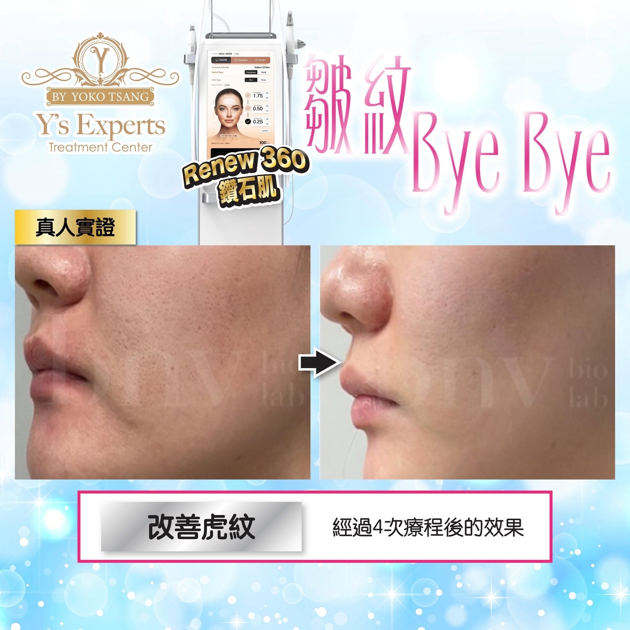 Renew360鑽石肌 真實案例 Before After